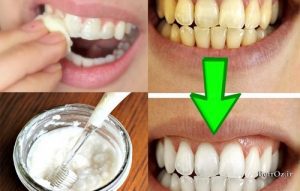 راه حل های خانگی برای سفید کردن دندان ها