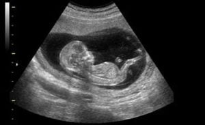 4 بار سونوگرافی در دوران بارداری ضروری و مهم است