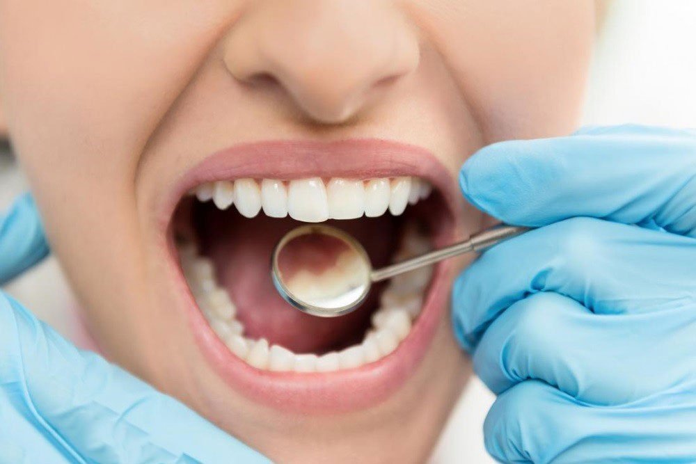  رعایت نکردن بهداشت دهان و دندان ها از علل بوی بد دهان