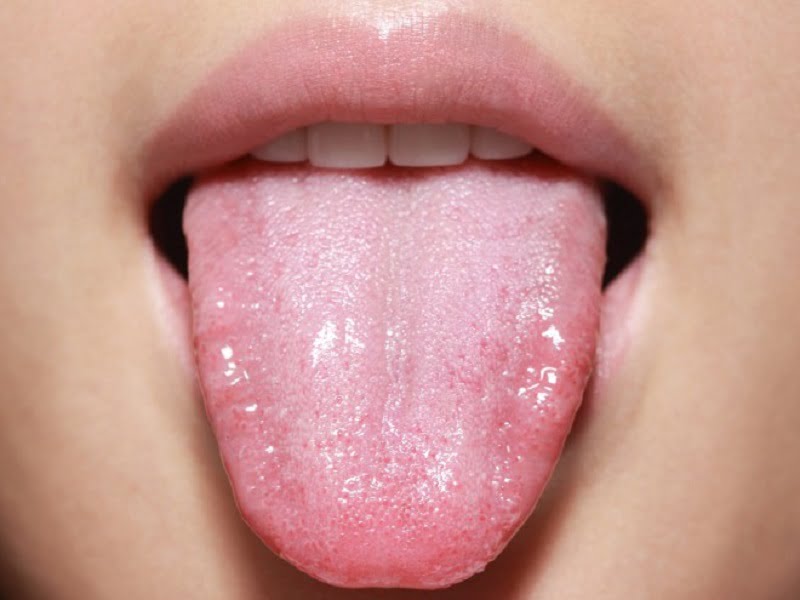 خشک و سفید بودن زبان از نشانه های بوی بد دهان