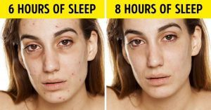 اثرات بی خوابی بر روی پوست